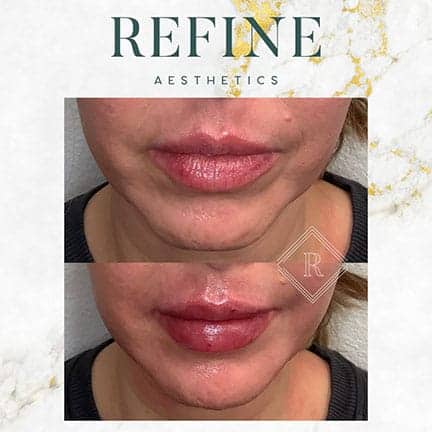 Lip Filler Before and After #4