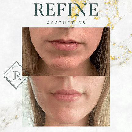 Dermal Fillers Before and After Results