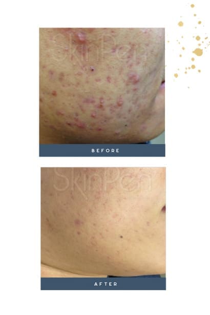 microneedling​ before and after