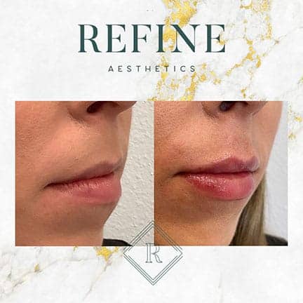 Lip Filler Before and After #2