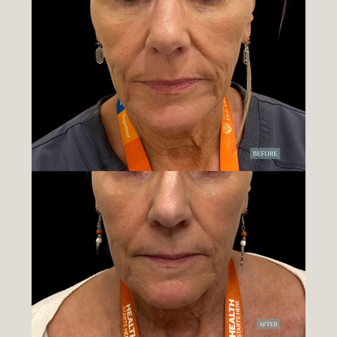 Before and after results from Sculptra in Austin showing restored facial volume and smoother skin around the mouth and jawline in a female patient.