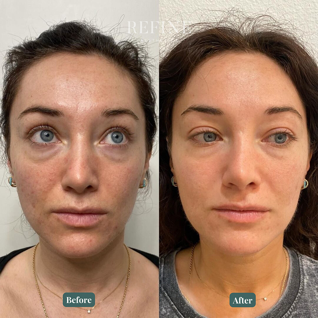 A before and after of a BBL Halo treatment in Austin, Texas