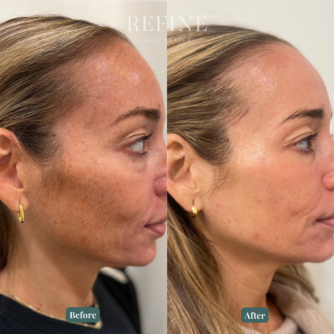 MOXI-PEEL-Diamond-Glow Before and after Diamond Glow facial in Austin, Texas