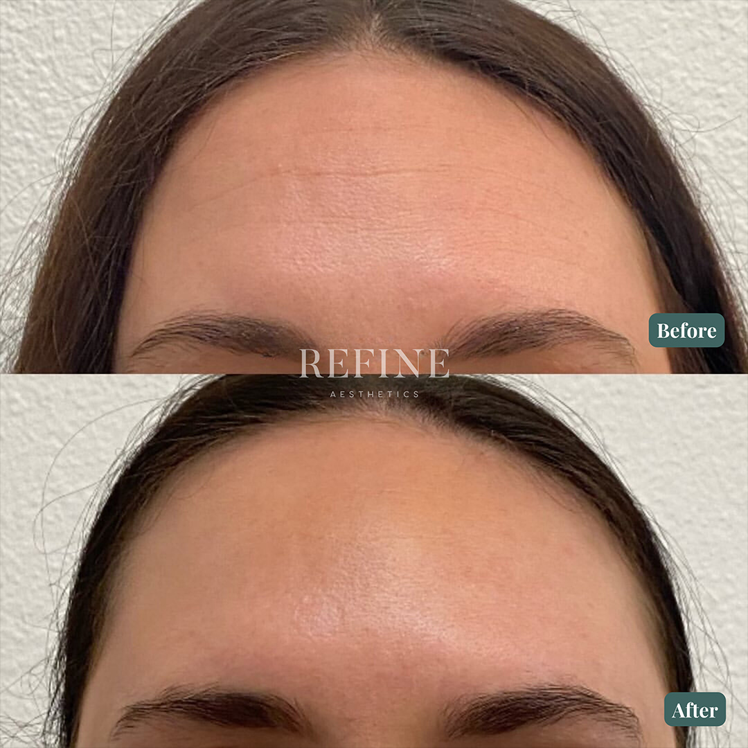 Neurotoxin-Jeuvea-Foreheadu A client's forehead before and after Jeuveau treatments in Austin, Texas