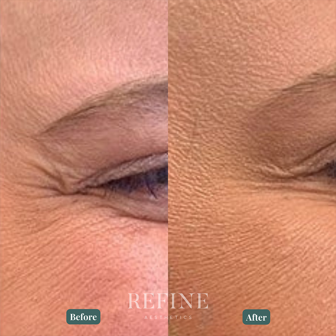 jeuveau before and after image of a patient's eyes after Jeuveau in Austin, Texas