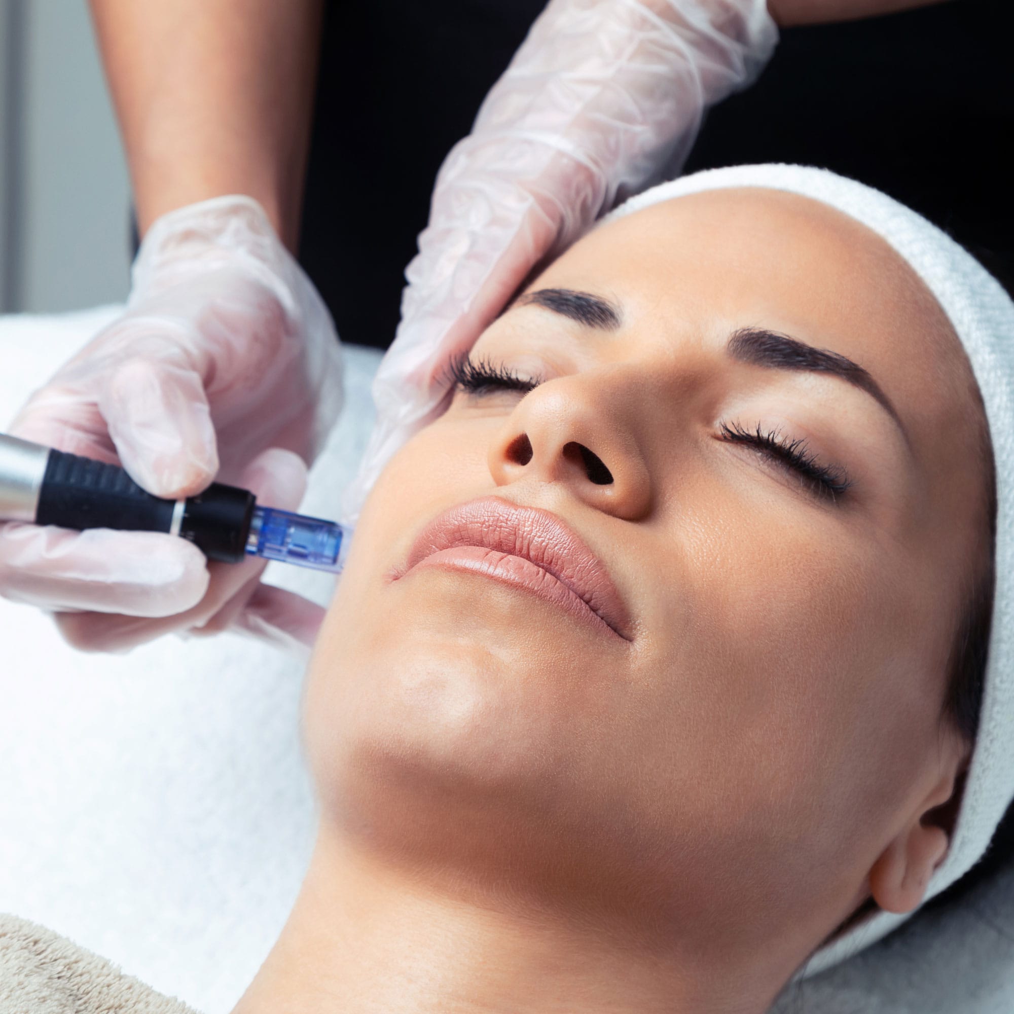 Microneedling: Buy 3, get the 4th free